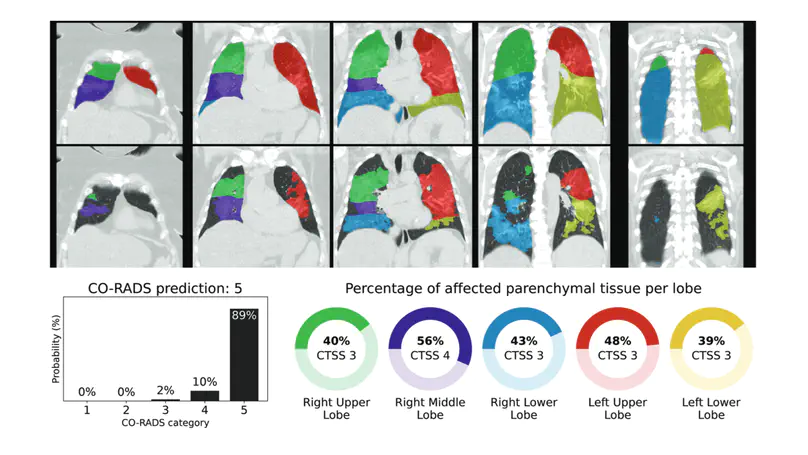 Automated Assessment of COVID-19 Reporting and Data System and Chest CT Severity Scores in Patients Suspected of Having COVID-19 Using Artificial Intelligence