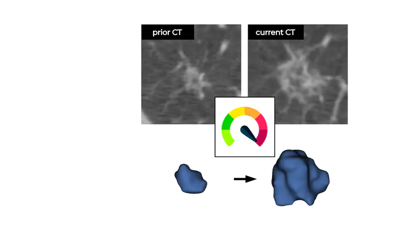 Prior CT Improves Deep Learning for Malignancy Risk Estimation of Screening-detected Pulmonary Nodules